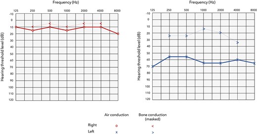 Audiogram demonstrating a moderately severe conductive hearing loss on the left side, and normal hearing on the right side.
