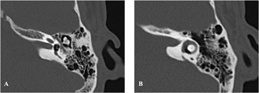 Axial HRCT of the left temporal bone showing medial displacement of the stapes into the vestibule (A), and the presence of air bubbles (pneumolabyrinth) inside the vestibule (A) and horizontal semicircular canal (B).