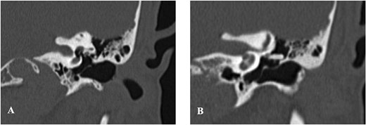 Coronal HRCT of the left temporal bone illustrating stapes footplate depression into the vestibule (A), and disruption of the incudostapedial joint with the long process of the incus directed superiorly toward the tympanic segment of the facial nerve (B).