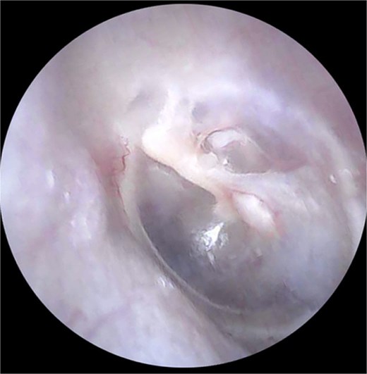Otoscopic examination after surgery showing complete healing of the tympanic membrane perforation.