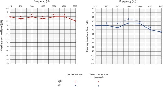 Postoperative audiogram indicating improvement in auditory function with significant air-bone gap closure and preservation of bone conduction thresholds.