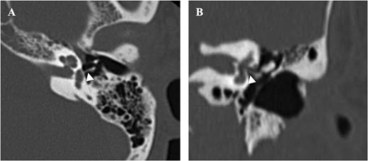 Postoperative HRCT obtained 6 months after surgery (A): Axial, (B): Coronal, indicating complete regression of the pneumolabyrinth and proper placement of the piston into the oval window (arrowhead).