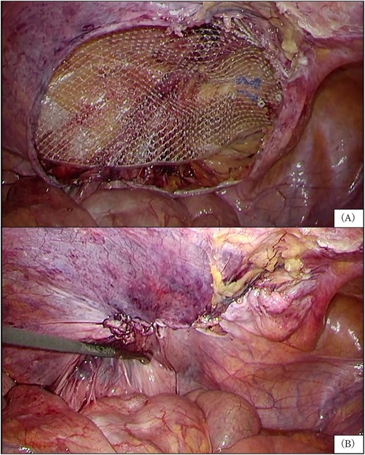 Laparoscopic view showing mesh placement in the preperitoneal space and subsequent peritoneal closure during initial TAPP repair.