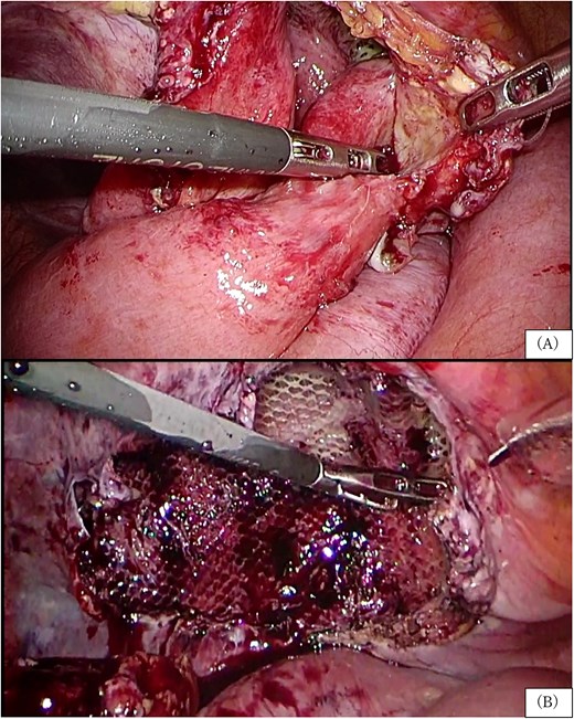Laparoscopic view at reoperation showing small bowel incarceration through a peritoneal defect and findings after adhesiolysis.