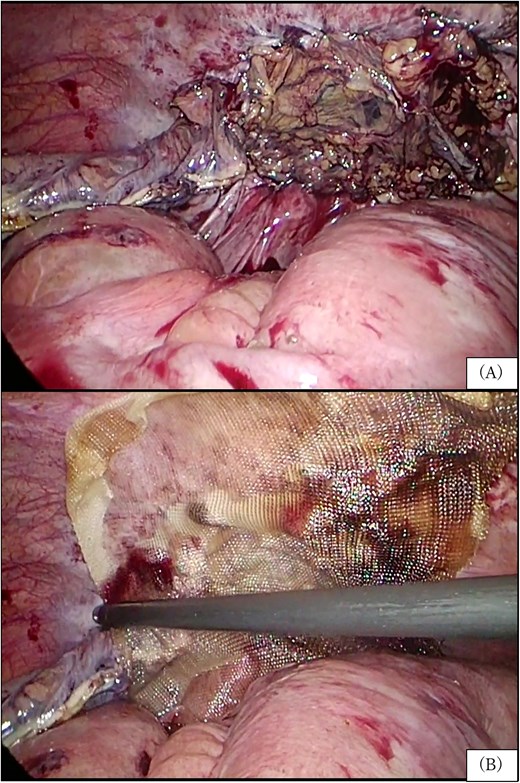 Laparoscopic view showing coverage of the peritoneal defect using a pedicled omental flap with reinforcement by an anti-adhesion barrier.