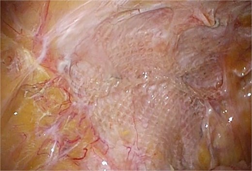 Laparoscopic view four years after reoperation showing regenerated peritoneum without adhesion.