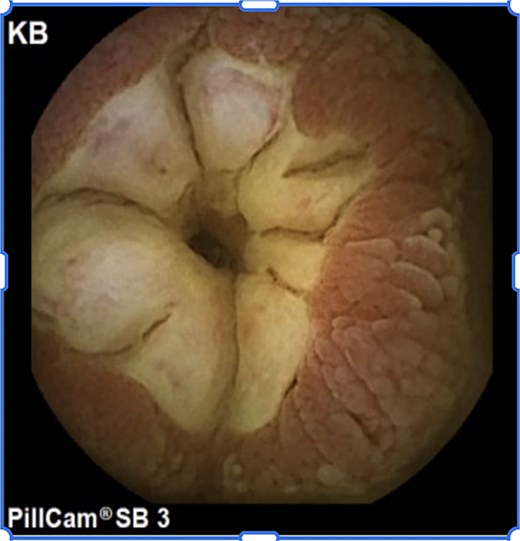 Capsule endoscopy image demonstrating circumferential narrowing of the jejunal lumen with ulceration and inflamed mucosa.