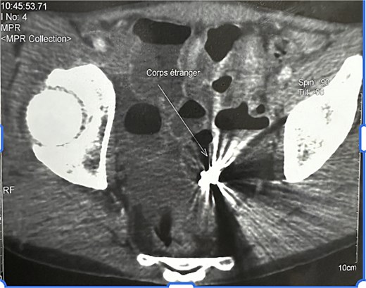 Axial abdominal CT scan showing a hyperdense capsule-shaped structure within a dilated jejunal loop.