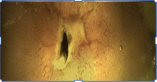 Capsule endoscopy image demonstrating narrowed ileal lumen with fibrotic stricture and mucosal ulceration.