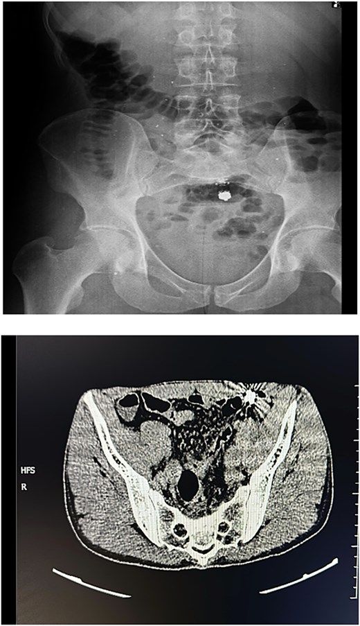 Plain abdominal radiograph and CT image showing a retained capsule within the proximal ileum.