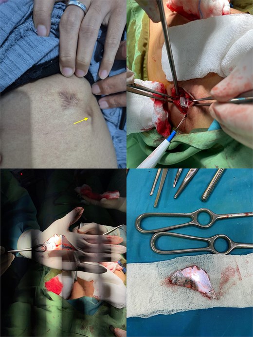 Four-panel clinical figure demonstrating identification, surgical removal, and retrieval of a retained foreign body beneath a previous scar.