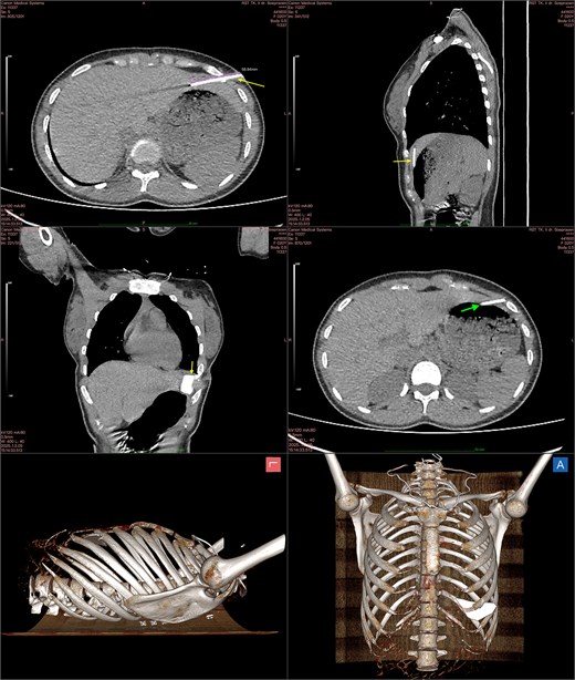 Multiplanar chest CT and 3D reconstructions demonstrating a retained foreign body traversing the left thoracoabdominal wall with suspected gastric penetration and measurement of the object length.