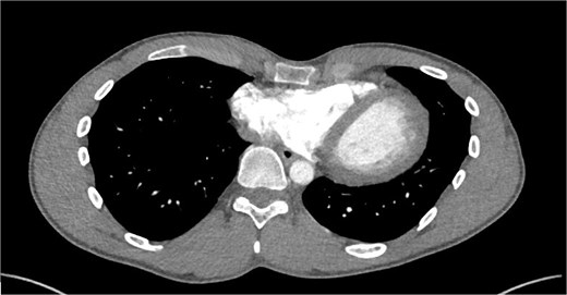 Axial CT scan of the chest portraying the heart, lungs, spine, and ribs in a cross-section.