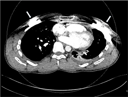 Axial CT scan of the chest portraying the heart, lungs, spine, and ribs in a cross section. The titanium bar can be seen on the left and right sides of the image.