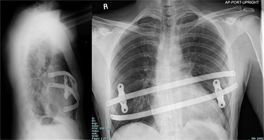 Chest X-ray portrays two horizontal titanium bars fixed across the chest viewed from both lateral and frontal perspectives.