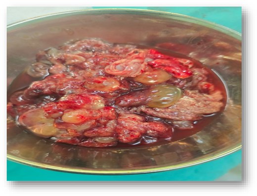Intraoperative photograph of a ruptured left ovarian mass displayed in a surgical basin, showing hemorrhagic tissue with multiple cystic structures of varying sizes containing greenish-yellow and dark brown fluid, consistent with a complex ruptured ovarian cyst or teratoma with intraoperative bleeding.