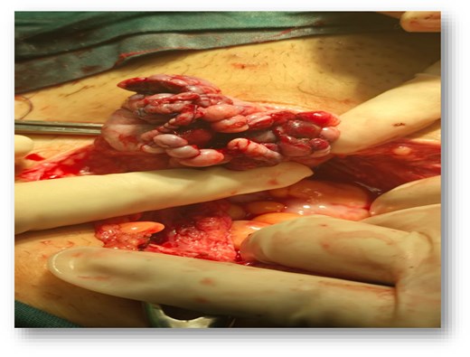 Intraoperative photograph showing the postreconstruction appearance of the left ovary held between gloved surgical hands, displaying a lobulated, hemorrhagic ovarian surface with multiple irregular nodular structures following surgical repair, set against a background of surgical drapes and surrounding tissues.