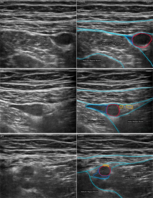 Three paired ultrasound images showing the distal femoral triangle and adductor canal at progressively distal levels, with unannotated images on the left and labelled images on the right. Panel A shows the distal femoral triangle at its apex, where the medial border of the sartorius crosses the medial border of the adductor longus. Panel B shows the proximal adductor canal immediately distal to the femoral triangle, within the subsartorial aponeurotic compartment. Panel C shows the distal adductor canal just proximal to the adductor hiatus, where the femoral artery exits the canal to become the popliteal artery.