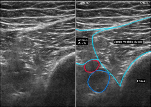 Paired ultrasound images showing the anatomical target for the proximal approach to the infiltration between the popliteal artery and the capsule of the knee block. The unannotated image is shown on the left and the labelled image on the right. The femoral artery and vein lie posterior to the sartorius and vastus medialis muscles and adjacent to the femur. Local anaesthetic is intended to be deposited in the tissue plane between the femur and the popliteal fossa.