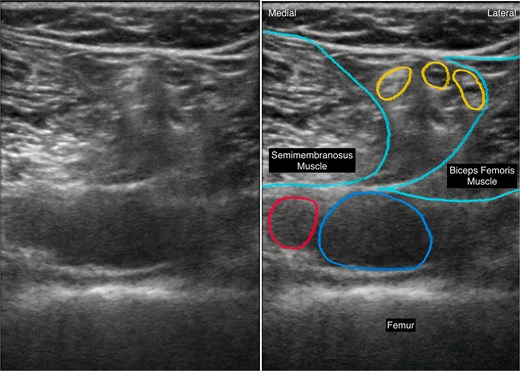 Paired ultrasound images showing the anatomical target for the distal approach to the infiltration between the popliteal artery and the capsule of the knee block. The unannotated image is shown on the left and the labelled image on the right. The popliteal artery and vein are located posterior to the femur within the popliteal fossa, between the semimembranosus and biceps femoris muscles, with adjacent neural structures shown superficially.