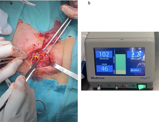 Intraoperative photograph showing PTeye probe contact with suspected parathyroid tissue and console display confirming autofluorescence detection.