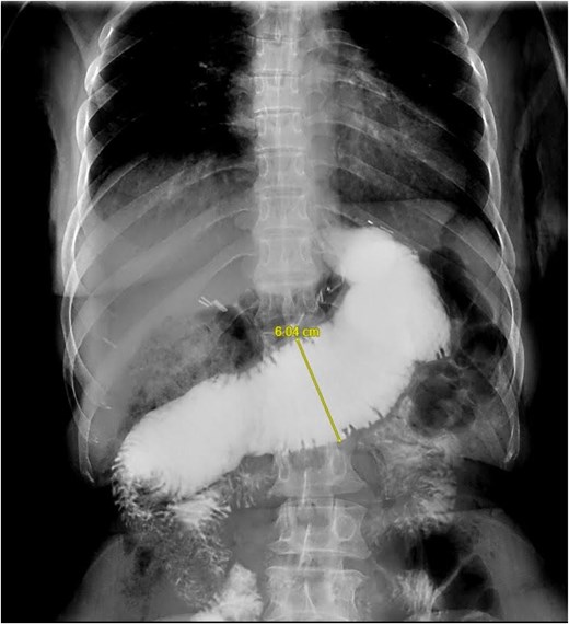 UGI (upper gastrointestinal) contrast study showed adilated alimentary limb with severe reflux.