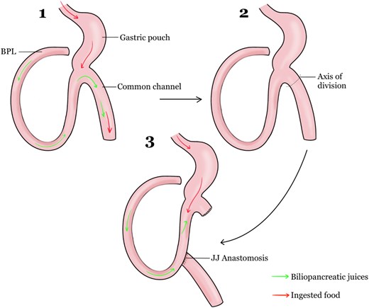 During conversion to RYGB, the common channel was been divided and anastomosed to the same biliary limb, resulting in an O-configuration.