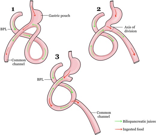 The OAGB was constructed with the biliary limb running from left to right, but the limb became twisted or flipped during conversion. Consequently, the common channel have been inadvertently divided and anastomosed to the biliary limb, producing the Oconfiguration