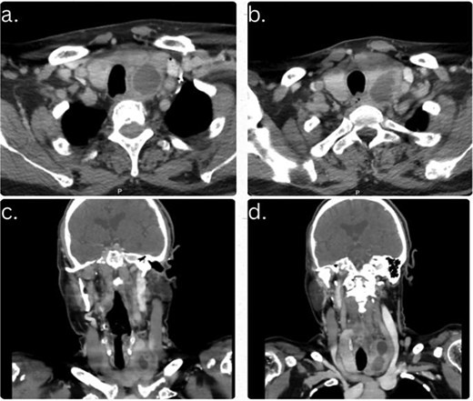 Contrast-enhanced CT neck images demonstrating a left inferior parathyroid cystic lesion measuring 4.5 x 2 x 5.2 cm (AP x TR x CC). (a and b) Axial views showing a well-defined hypodense cystic lesion posterior to the lower pole of the left thyroid lobe. (c and d) Coronal views demonstrating the extent of the retrothyroid cystic lesion without solid enhancement, calcification, or local invasion.