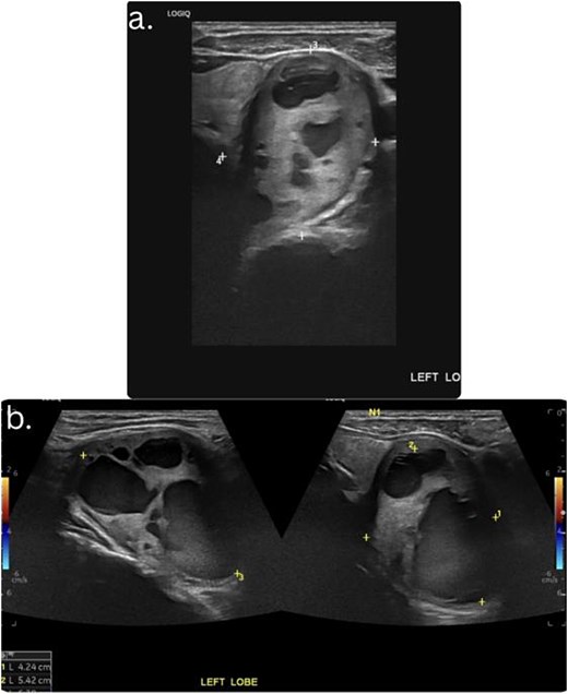 Ultrasound images of the thyroid and parathyroid region. (a and b) Longitudinal and transverse ultrasound views showing a large cystic lesion adjacent to the left thyroid region.