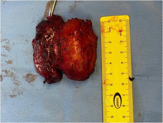 Large parathyroid mass was identified adherent to the left thyroid lobe.