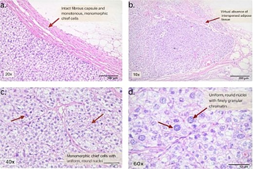 Histopathological examination of the parathyroid lesion (H and E stain). (a) Low-power view (20x) showing an intact fibrous capsule and monotonous, monomorphic chief cells. (b) Low-power view (10x) demonstrating virtual absence of interspersed adipose tissue. (c) High-power view (40x) showing monomorphic chief cells with uniform, round nuclei. (d) High-power view (60x) demonstrating uniform round nuclei with finely granular chromatin.