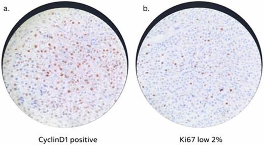 Immunohistochemical staining of the parathyroid lesion. (a) Cyclin D1 immunostain demonstrating positive nuclear expression in tumor cells. (b) Ki-67 immunostain showing a low proliferative index of ~2%. Upon the patient's follow-up with endocrinology and surgery, his tremors and fatigue significantly improved, and no hypocalcemia symptoms were perceived. After 4 months from surgery, the patient had a normal calcium level with slightly elevated parathyroid hormone (14 pmol/l) pertaining to his chronic kidney disease, and a slightly insufficient level of vitamin D (71.68 nmol/l).