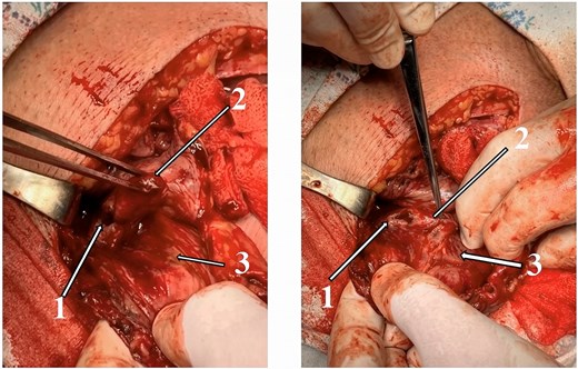 Two intraoperative photographs showing a perforated gangrenous appendix within an Amyand's hernia. Numbered labels identify the perforated appendix, the distal appendix within the hernia sac, and the thickened hernia sac containing the cecum and appendix.