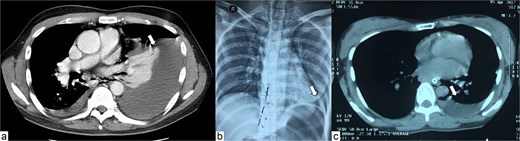 Chest X-ray and CT scan of the patients. Panel A shows marked pleural effusion (white arrow) on contrast-enhanced CT scan of the first patient. Panel B shows chest X-ray findings of the second patient, note that there was unclear pleural effusion on initial X-ray (white arrow). Panel C shows non-contrast CT findings of the second patient, with marked pleural effusion (white arrow).