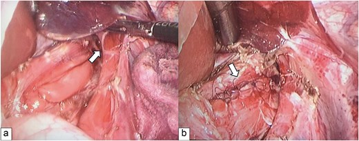Intraoperative findings and management. Panel A shows a 3.5 cm tear of the distal esophagus, as found upon laparoscopy (white arrow). Panel B shows the full-thickness repair (white arrow).