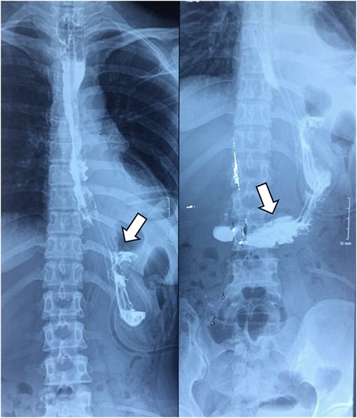 Postoperative contrast esophagogram, showing normal esophago-gastric contrast flow was noted, with no leakage (white arrow).