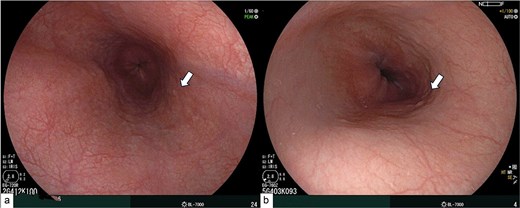 Follow-up esophagogastroduodenoscopy after 2 years. Panel A shows the esophagogastroduodenoscopy findings of the first patient, with no visible scarring (white arrow). Panel B shows the esophagogastroduodenoscopy of the second patient, with minimal scarring (white arrow).