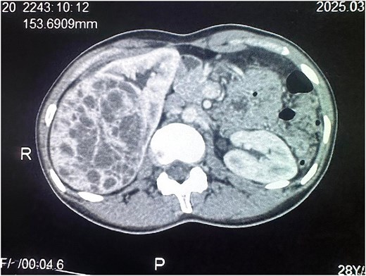 Axial cut of contrast-enhanced CT scan of the abdomen at the level of the kidneys. A heterogeneously enhancing mixed solid and cystic lesion measuring 9.9 x 7.3 x 9.0 cm arising from the interpolar region of the right kidney is visible.