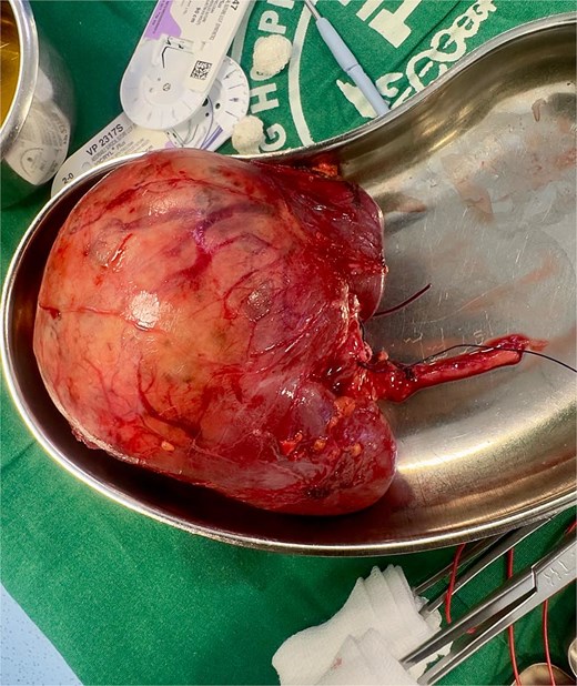 Appearance of a large renal mass on macroscopic pathological examination. The specimen weighed 554 grams and measured 12 x 7.8 x 7 cm with a 5.5 cm long ureter attached. The tumor was well circumscribed with a grossly intact capsule.