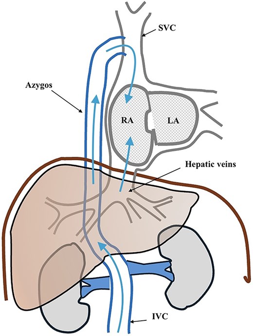 Schematic diagram of interrupted inferior vena cava with azygos continuation. Venous blood from the infrarenal inferior vena cava ascends through an enlarged azygos vein to the superior vena cava before entering the right atrium, while the hepatic veins drain directly into the right atrium. The right and left atria are labeled, and arrows indicate the direction of venous blood flow.