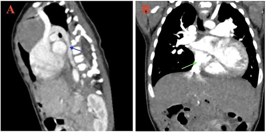 Contrast-enhanced sagittal and coronal CT images demonstrating interrupted inferior vena cava with azygos continuation. The azygos vein drains into the superior vena cava, and the hepatic veins drain directly into the right atrium. Colored arrows indicate the key vascular findings.