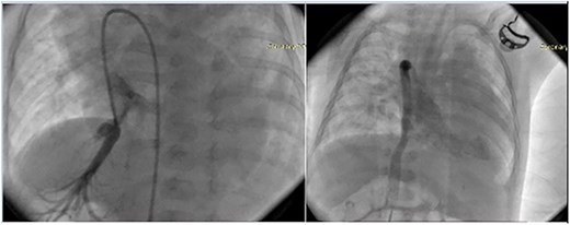 Two fluoroscopic images obtained during cardiac catheterization. The catheter introduced from the femoral vein follows an interrupted inferior vena cava and ascends through a dilated azygos vein before entering the superior vena cava and right atrium, demonstrating azygos continuation of the interrupted inferior vena cava.