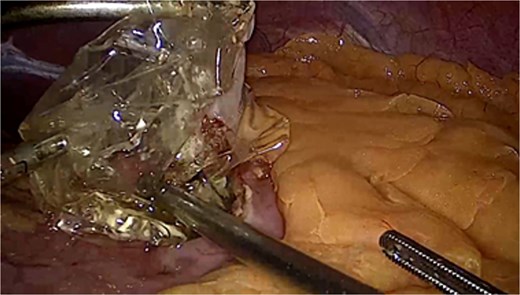 Laparoscopic camera view showing intrabdominal cavity and removal of the balloon through gastrostomy.