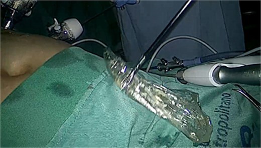 Laparoscopic camera view showing sterile field with the removed balloon over it.
