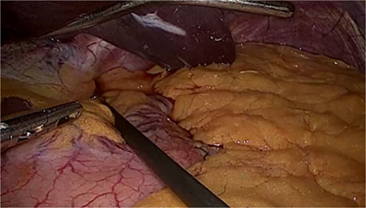 Laparoscopic camera view showing intrabdominal cavity with sliding hiatal hernia on focus.
