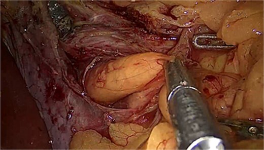Laparoscopic camera view of paraoesophageal lipoma being hold by forceps to show its considerable size.