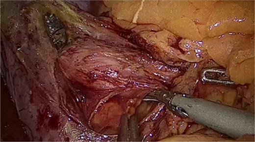 Laparoscopic camera view showing the intrabdominal cavity with the anterior hernia defect on focus.