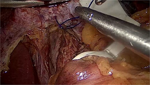 Laparoscopic camera view showing the posterior hernial defect after dissection.