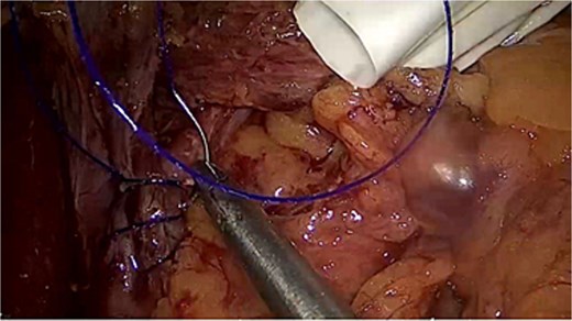 Laparoscopic camera view showing the anterior defect being repaired.